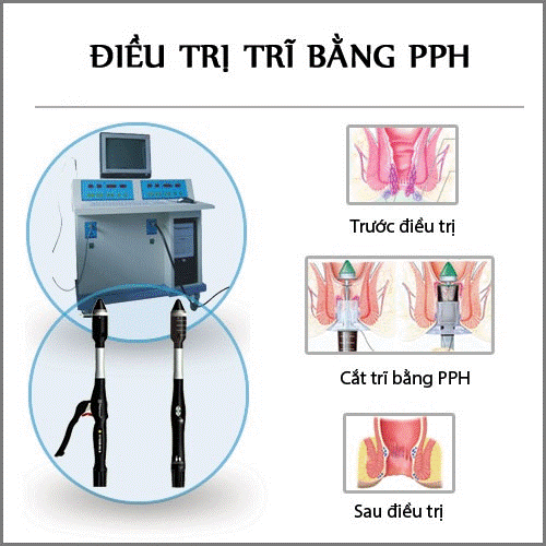 Cách trị bệnh trĩ bằng phương pháp PPH